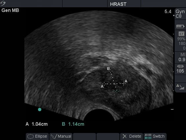 ultrazvuk prostate